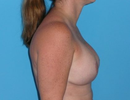 Breast Augmentation with Lift Before & After Patient #1041