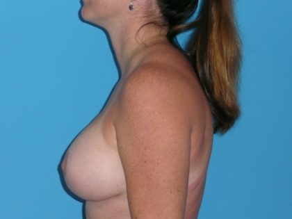 Breast Augmentation with Lift Before & After Patient #1041