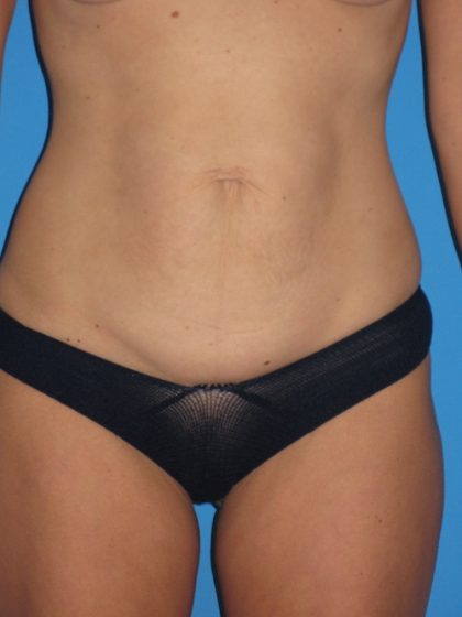 Tummy Tuck Before & After Patient #1334