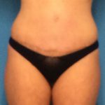 Tummy Tuck Before & After Patient #1334
