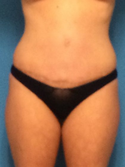 Tummy Tuck Before & After Patient #1334