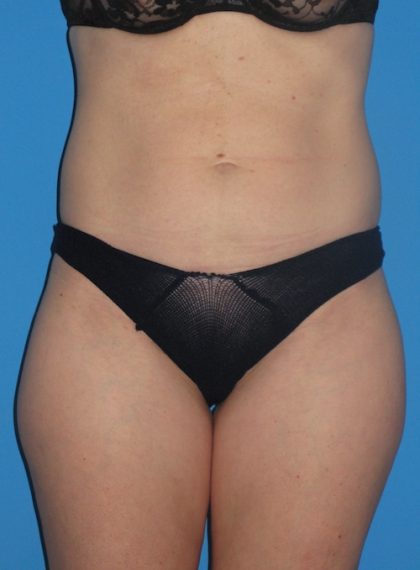 Liposuction Before & After Patient #1289