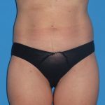 Liposuction Before & After Patient #1289