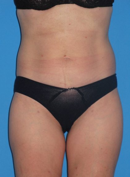 Liposuction Before & After Patient #1289