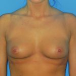 Breast Augmentation Before & After Patient #1005