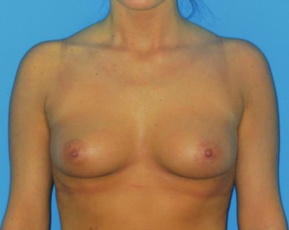 Breast Augmentation Before & After Patient #1005