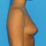 Breast Augmentation Before & After Patient #1005