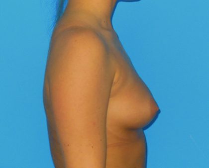 Breast Augmentation Before & After Patient #1005