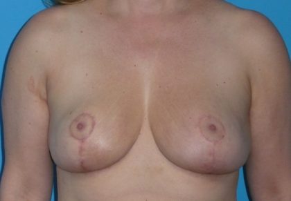 Breast Reduction Before & After Patient #1128