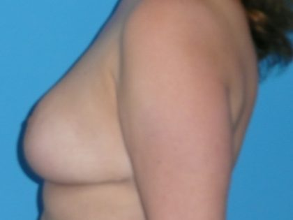 Breast Reduction Before & After Patient #1128