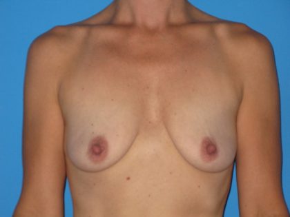 Breast Augmentation with Lift Before & After Patient #1063