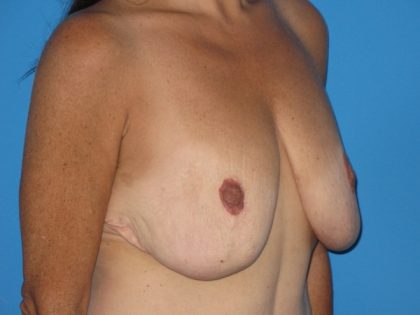 Breast Augmentation with Lift Before & After Patient #1072