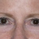 Blepharoplasty Before & After Patient #1405
