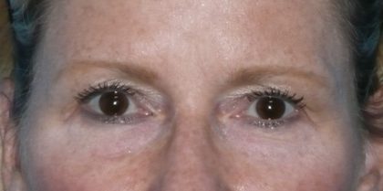 Blepharoplasty Before & After Patient #1405