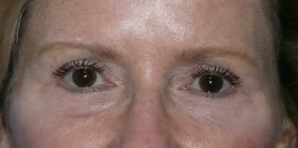 Blepharoplasty Before & After Patient #1405