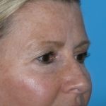 Blepharoplasty Before & After Patient #1405