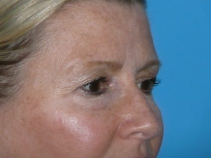 Blepharoplasty Before & After Patient #1405