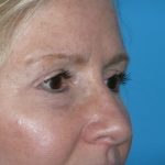 Blepharoplasty Before & After Patient #1405