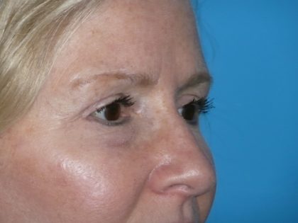 Blepharoplasty Before & After Patient #1405