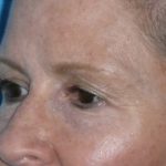 Blepharoplasty Before & After Patient #1405