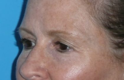 Blepharoplasty Before & After Patient #1405