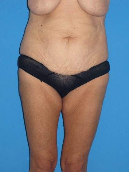 Body Lift Before & After Patient #1273