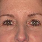 Blepharoplasty Before & After Patient #1412