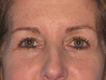 Blepharoplasty Before & After Patient #1412