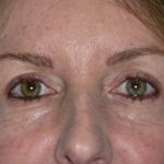 Blepharoplasty Before & After Patient #1412