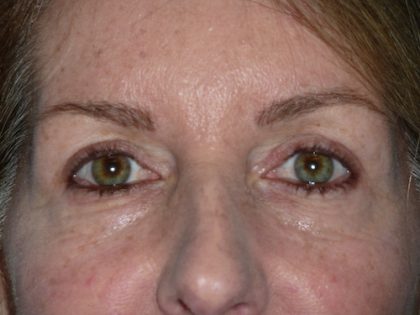 Blepharoplasty Before & After Patient #1412