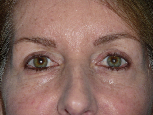 Blepharoplasty Before & After Patient #1412