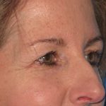 Blepharoplasty Before & After Patient #1412