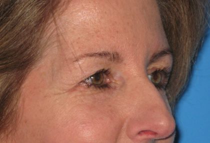 Blepharoplasty Before & After Patient #1412