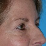 Blepharoplasty Before & After Patient #1412