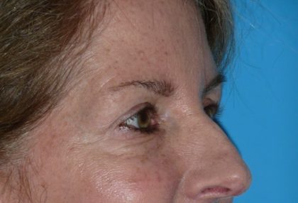 Blepharoplasty Before & After Patient #1412