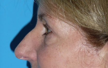 Blepharoplasty Before & After Patient #1412