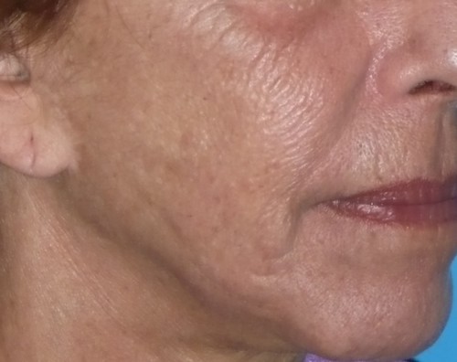 CO2 Laser Before & After Patient #1445