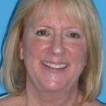 Facelift Before & After Patient #1486
