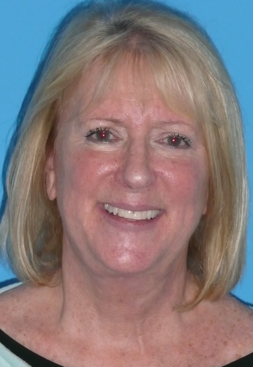 Facelift Before & After Patient #1486