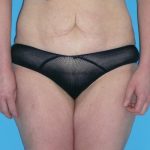 Tummy Tuck Before & After Patient #1339