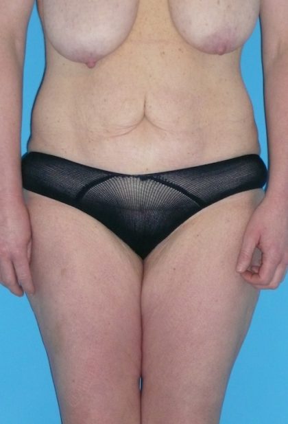 Tummy Tuck Before & After Patient #1339