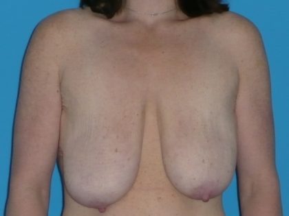 Breast Reduction Before & After Patient #1139