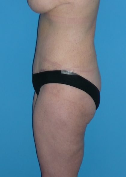 Tummy Tuck Before & After Patient #1339