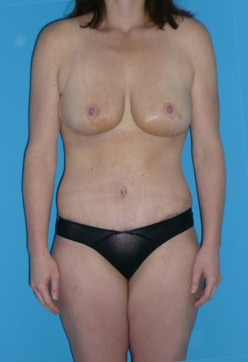 Mommy Makeover Before & After Patient #1299