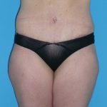 Tummy Tuck Before & After Patient #1339