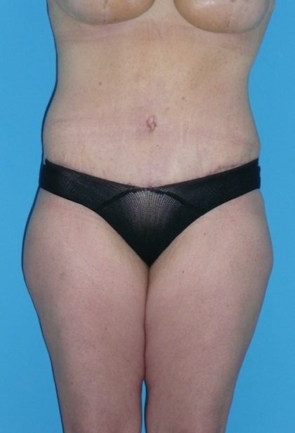Tummy Tuck Before & After Patient #1339