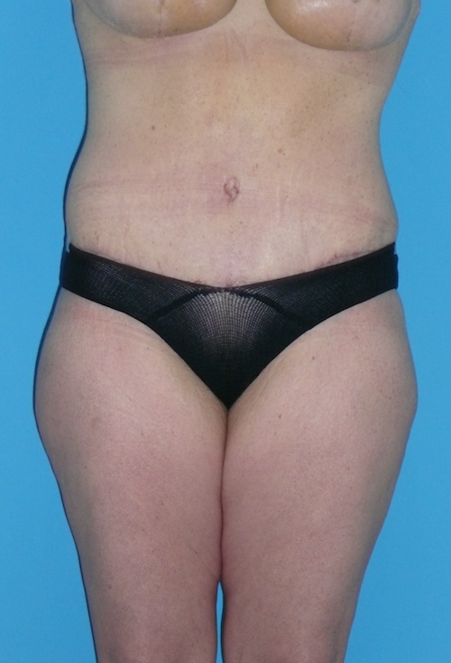 Tummy Tuck Before & After Patient #1339