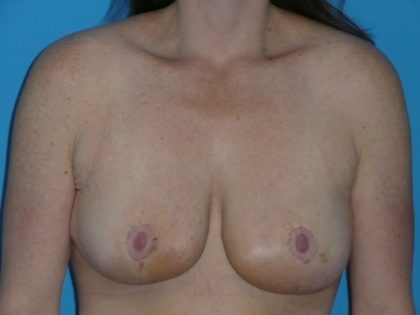 Breast Reduction Before & After Patient #1139