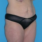 Tummy Tuck Before & After Patient #1339