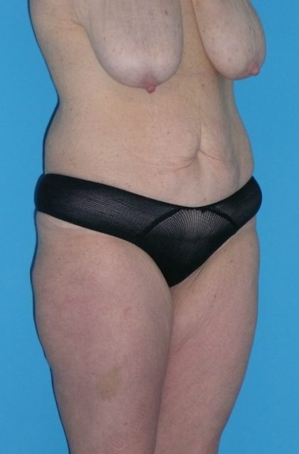 Tummy Tuck Before & After Patient #1339